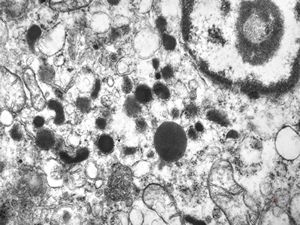 M, 38y. | pheochromocytoma